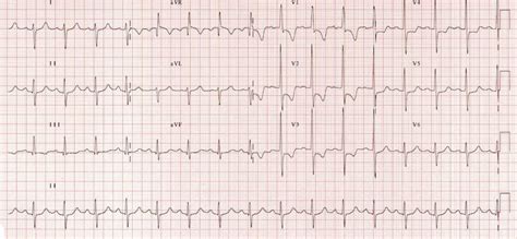 lv rv 85|Right heart strain .